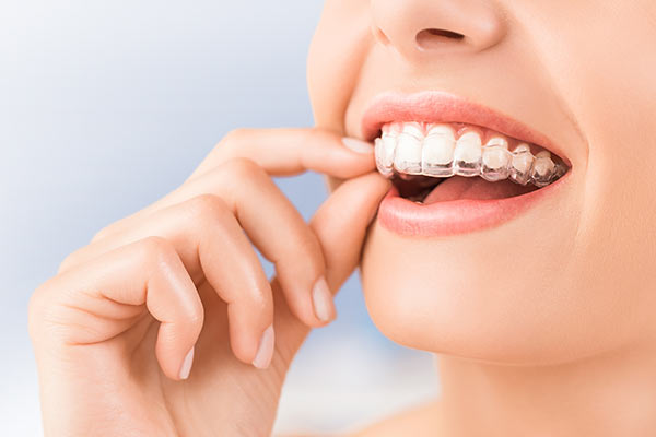 Tray Whitening