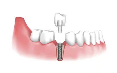 Am I a Candidate for Dental Implants? What You Need to Know